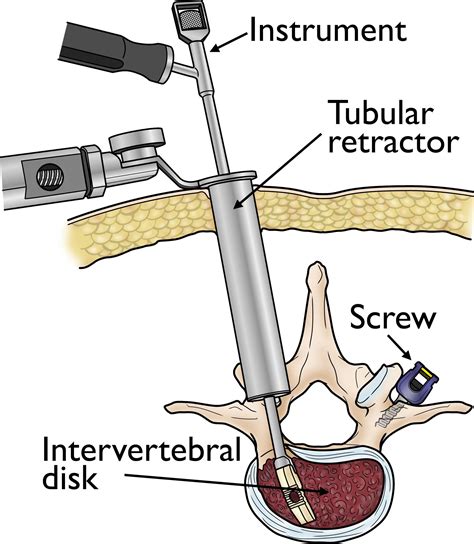 download Minimally Invasive Surgery of the Lumbar Spine